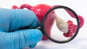 endometriozis-nedir-belirtileri-nelerdir-endometriozis-tedavisi-var-midir-8PBEvw8W.jpg