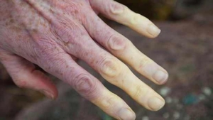 lupus-hastaligi-nedir-belirtileri-nelerdir-lupus-hastaligi-tedavisi-nedir-olumcul-mudur-Pv194Rhq.jpg