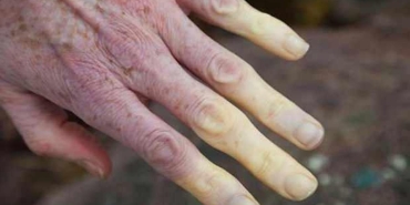 lupus-hastaligi-nedir-belirtileri-nelerdir-lupus-hastaligi-tedavisi-nedir-olumcul-mudur-Pv194Rhq.jpg
