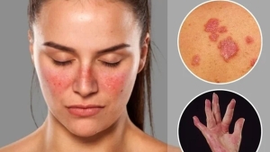 lupus-hastaligi-olumcul-mudur-neden-olur-lupus-hastaligi-tedavisi-nedir-jdKAPhcK.jpg